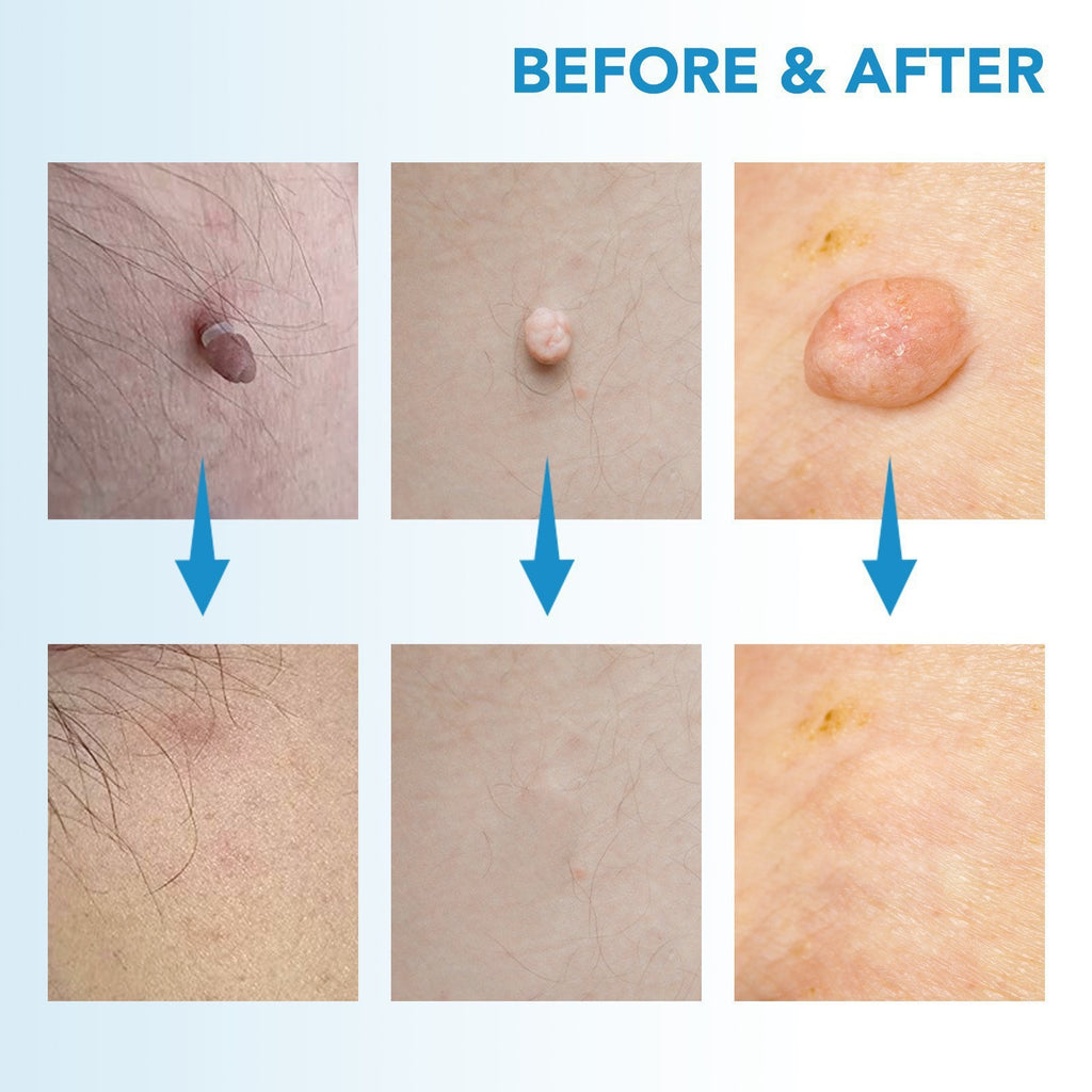 Skin Tag Removal Tool (Blue Box)