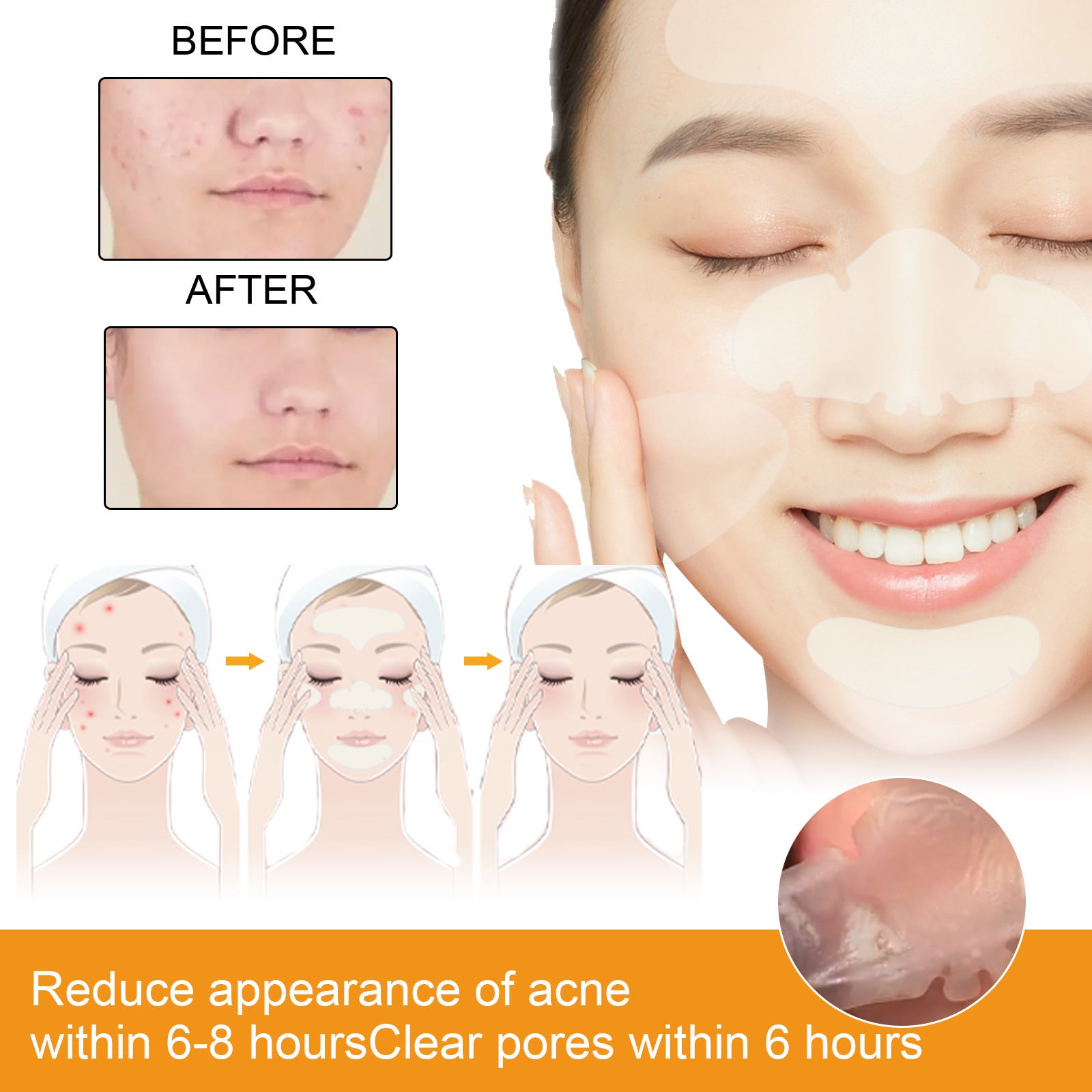 EELHOE hydrogel facial acne patch portable transparent invisible hydrogel anti-acne patch facial care concealer